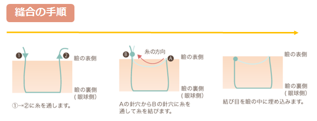 縫合手順