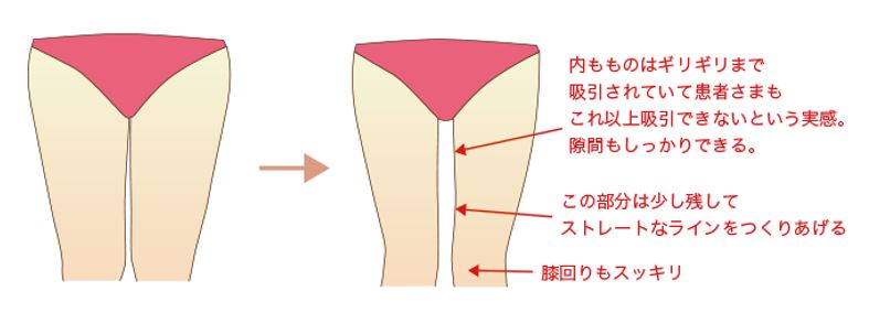 水の森の場合