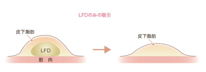 LFDのみ - コピー