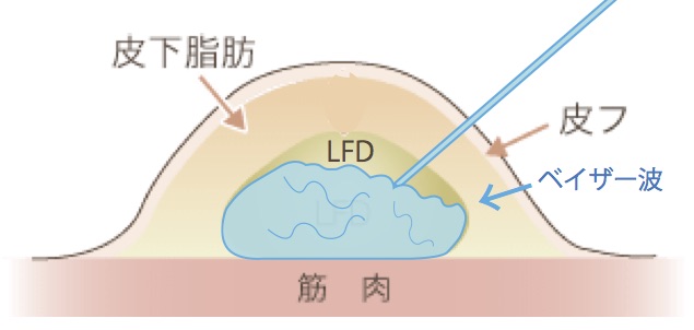 ベイザー脂肪吸引 (1)