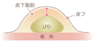 皮下脂肪