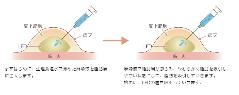 脂肪吸引1