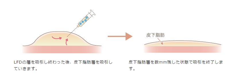 脂肪吸引2