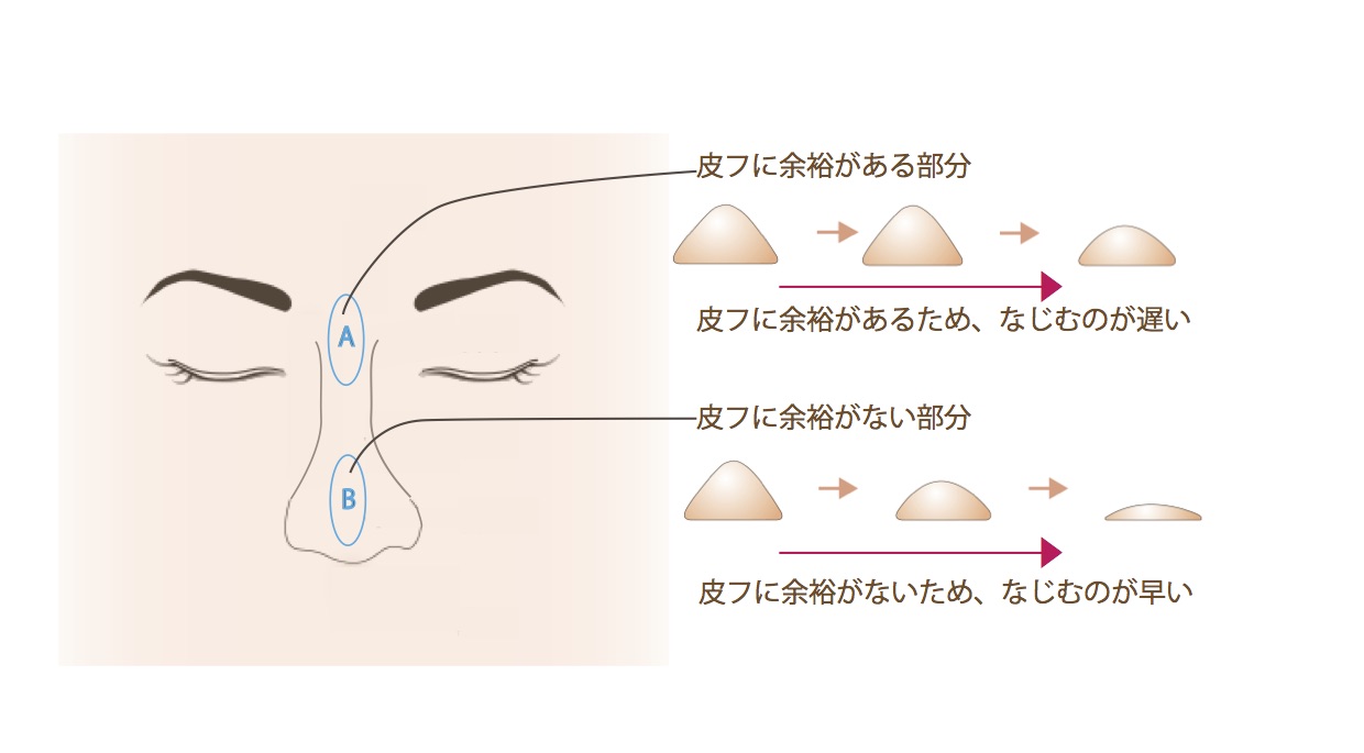 鼻の形悩み２