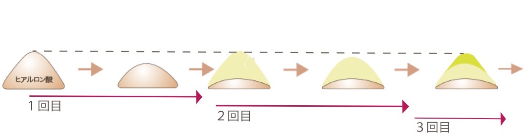 鼻ヒアルロン酸-図1-2