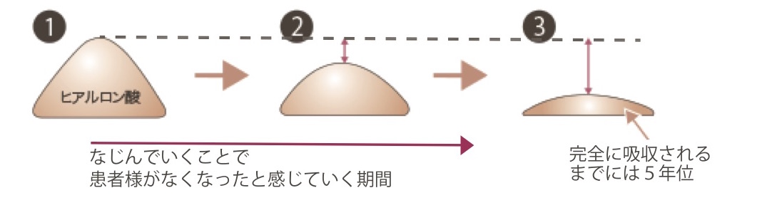 鼻ヒアルロン酸図1