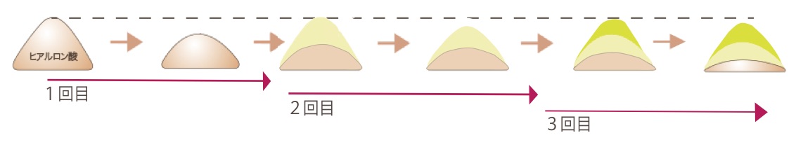 鼻ヒアルロン酸図１−２ (2)