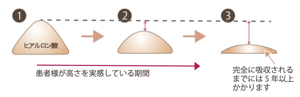 鼻ヒアルロン酸１−１